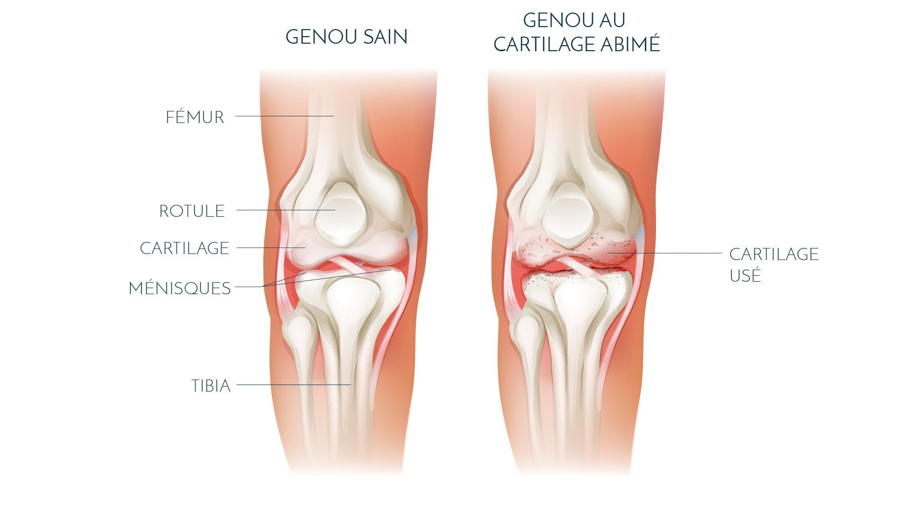 Genou - Orthopédie - A.F.I.D.E.O. - L'orthopédie en mouvement